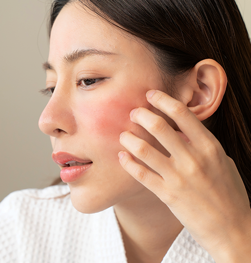 Blood Vessels, Redness & Angiomas