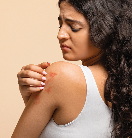 Eczema