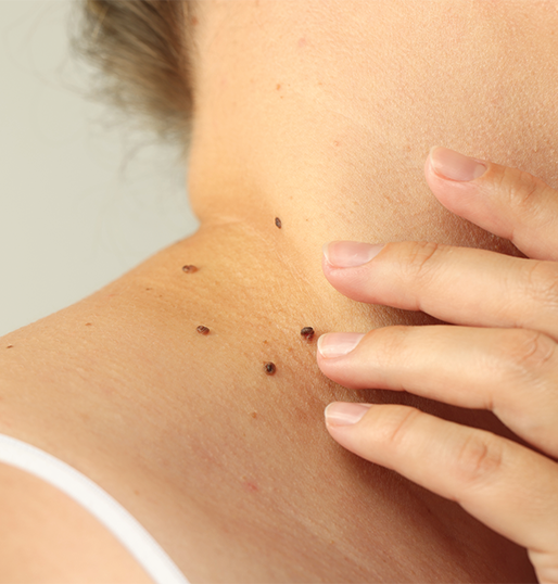 Skin Growths