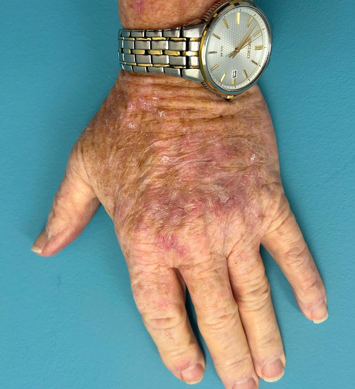 Dorsal Hand Defect – Mohs Surgery After Image