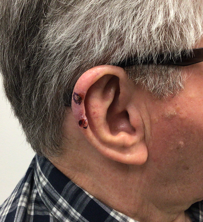 Helix Defect – Mohs Surgery Before Image