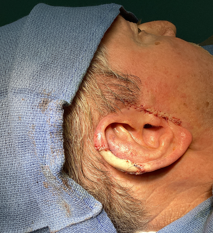 Helix Defect – Mohs Surgery After Image