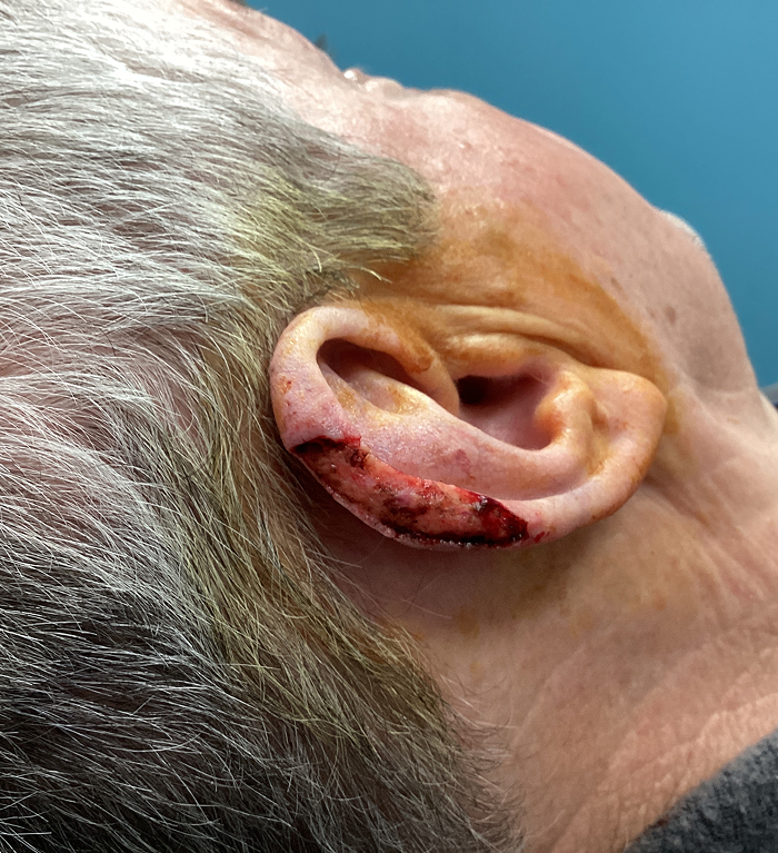 Helix Defect – Mohs Surgery Before Image