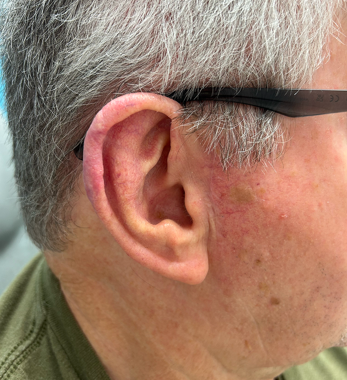 Helix Defect – Mohs Surgery After Image