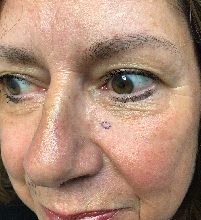 Infraorbital Cheek Defect – Mohs Surgery Before Image