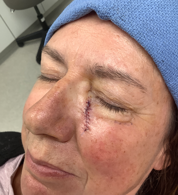 Infraorbital Cheek Defect – Mohs Surgery After Image
