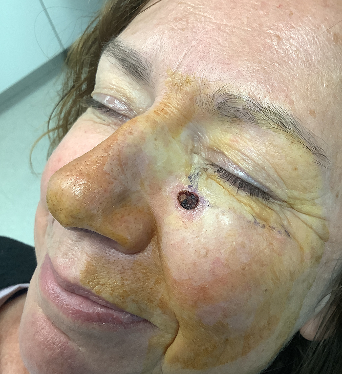 Infraorbital Cheek Defect – Mohs Surgery Before Image