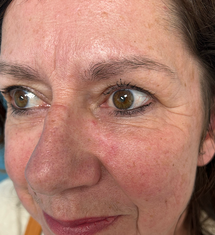 Infraorbital Cheek Defect – Mohs Surgery After Image