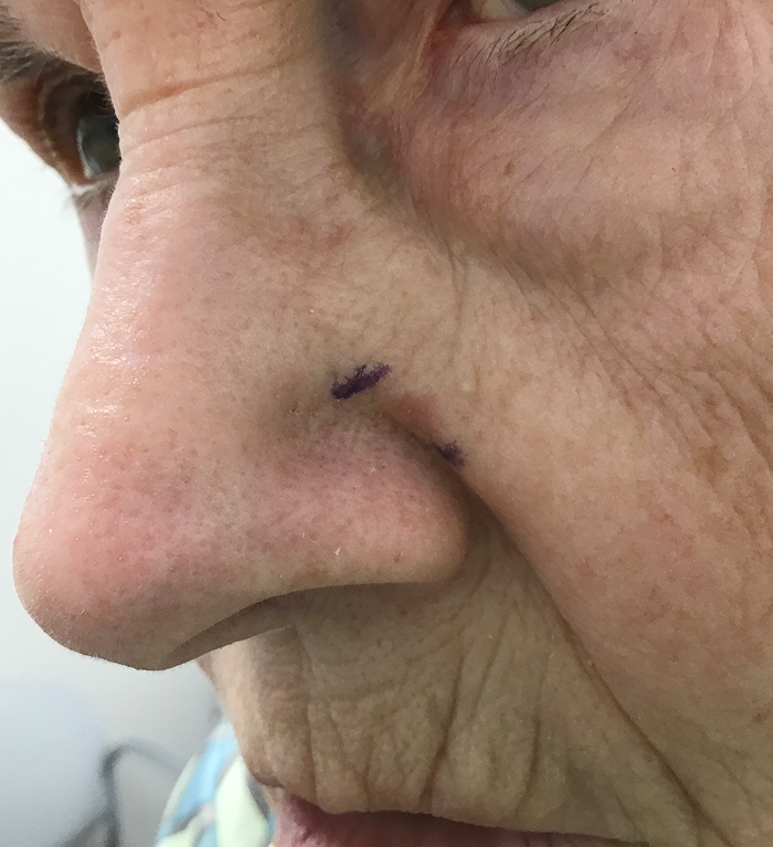 Left Cheek Defect – Mohs Surgery Before Image