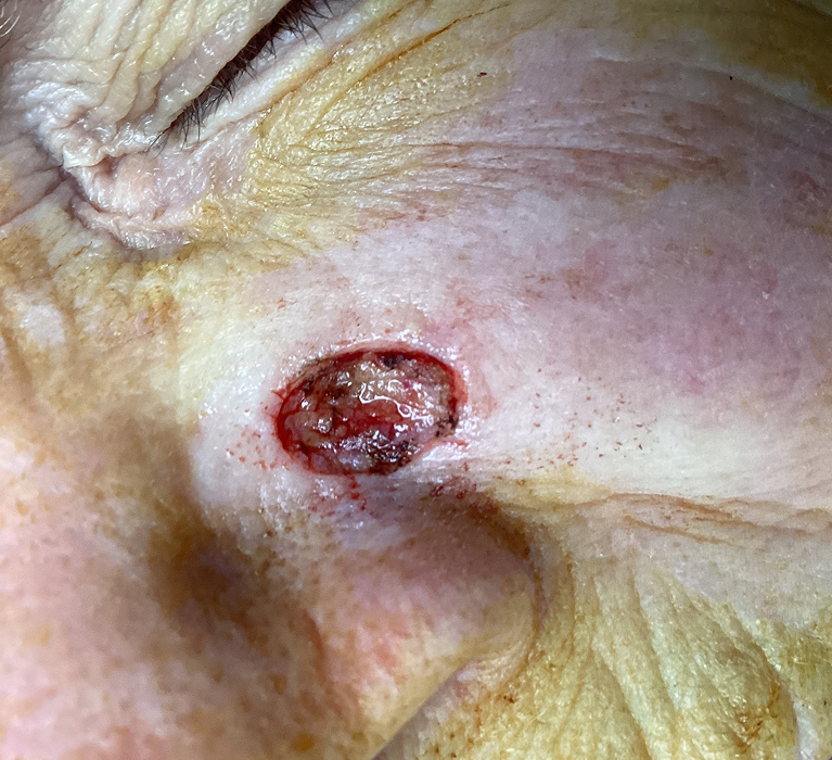 Left Cheek Defect – Mohs Surgery After Image