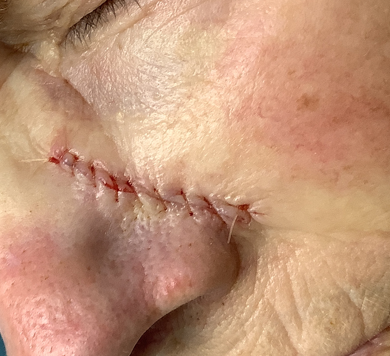 Left Cheek Defect – Mohs Surgery Before Image