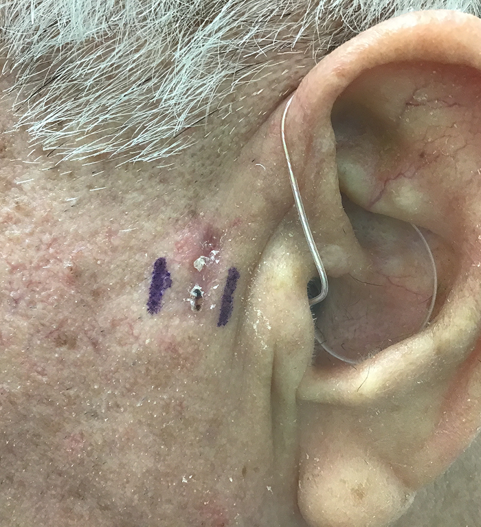 Left Preauricular Defect – Mohs Surgery Before Image