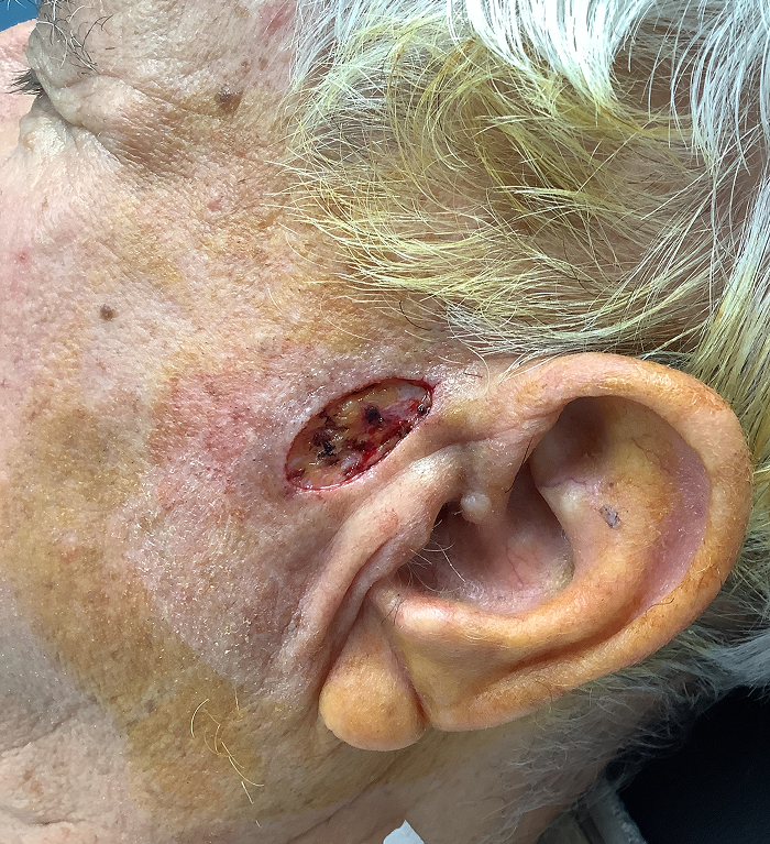 Left Preauricular Defect – Mohs Surgery After Image