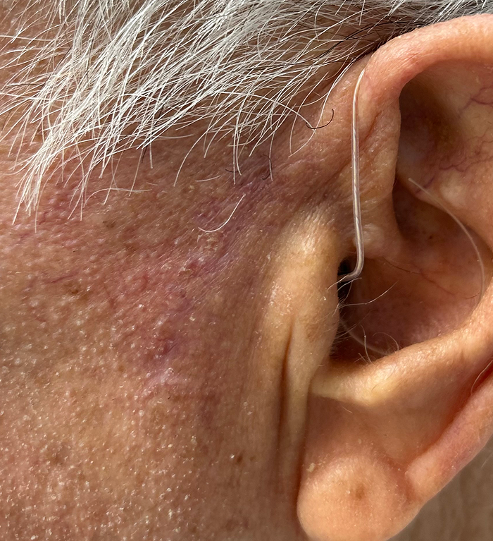 Left Preauricular Defect – Mohs Surgery After Image