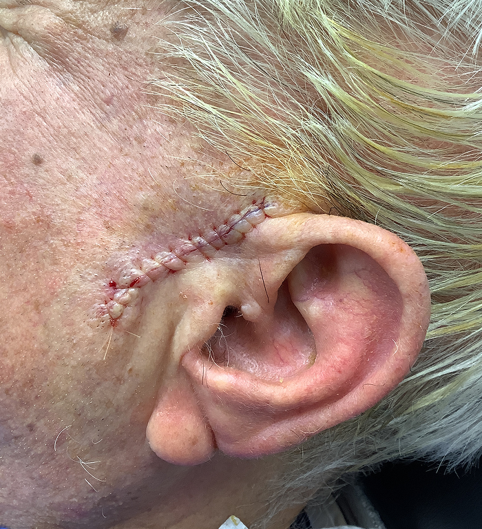 Left Preauricular Defect – Mohs Surgery Before Image
