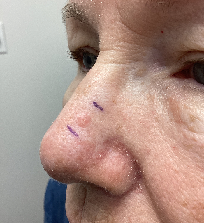 Nasal Sidewall Defect  – Mohs Surgery Before Image