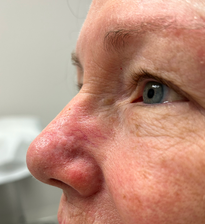 Nasal Sidewall Defect  – Mohs Surgery After Image