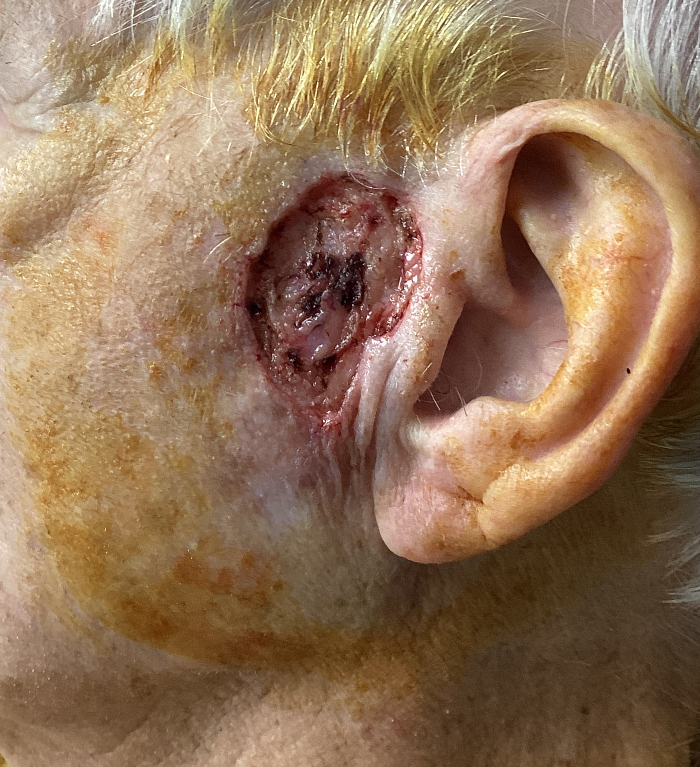Preauricular Defect – Mohs Surgery After Image