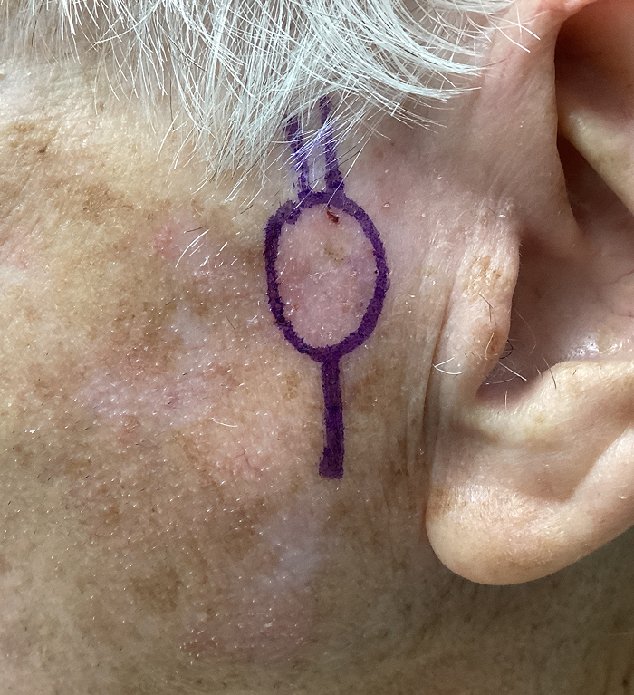 Preauricular Defect – Mohs Surgery Before Image