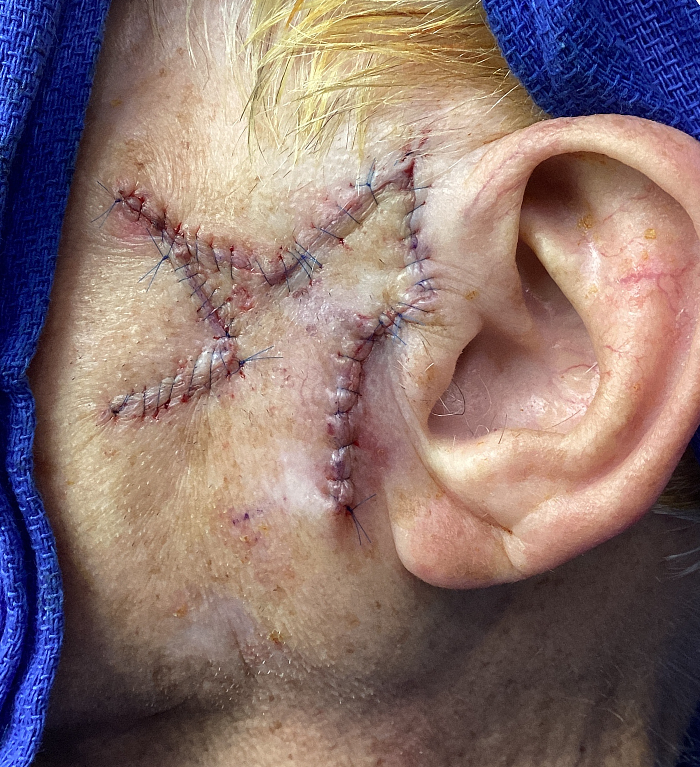 Preauricular Defect – Mohs Surgery Before Image