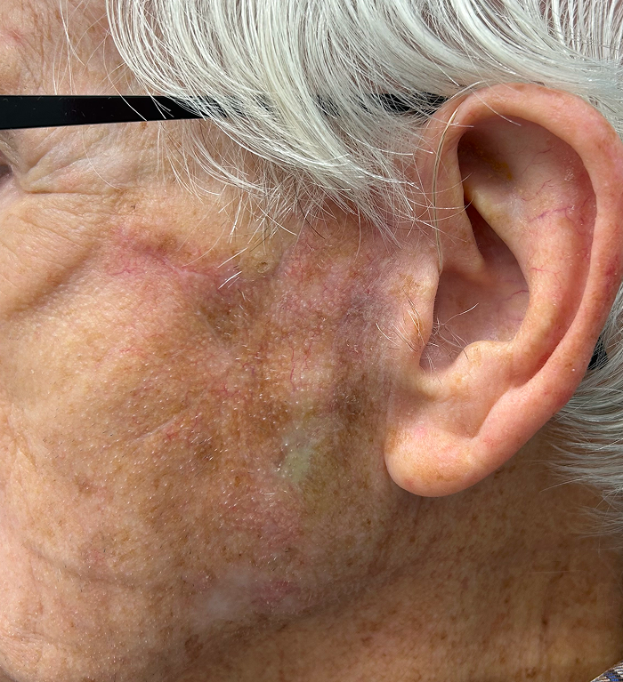 Preauricular Defect – Mohs Surgery After Image
