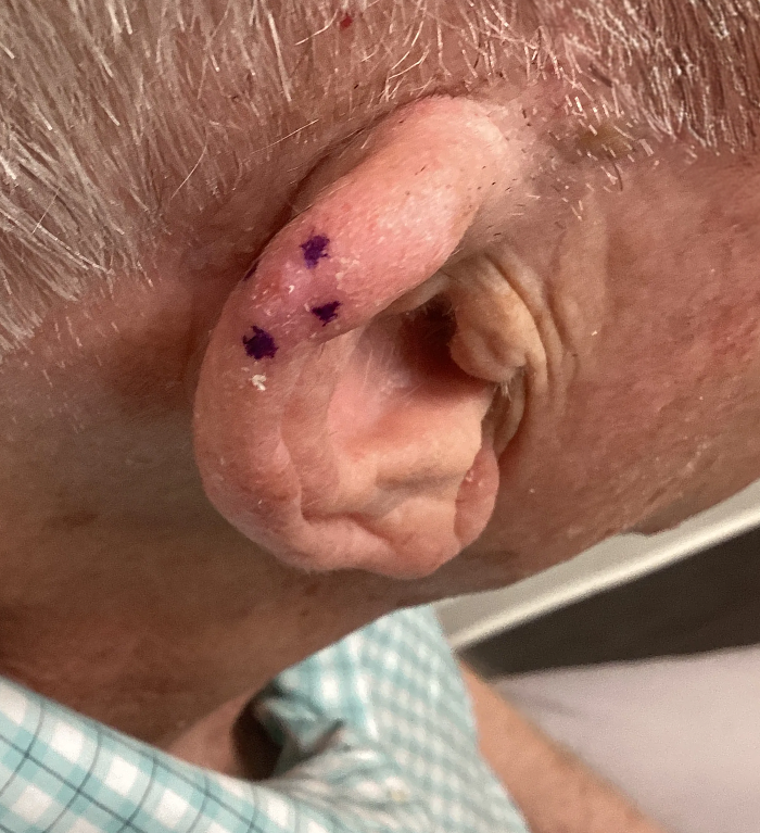 Right Helix Defect- Mohs Surgery Before Image