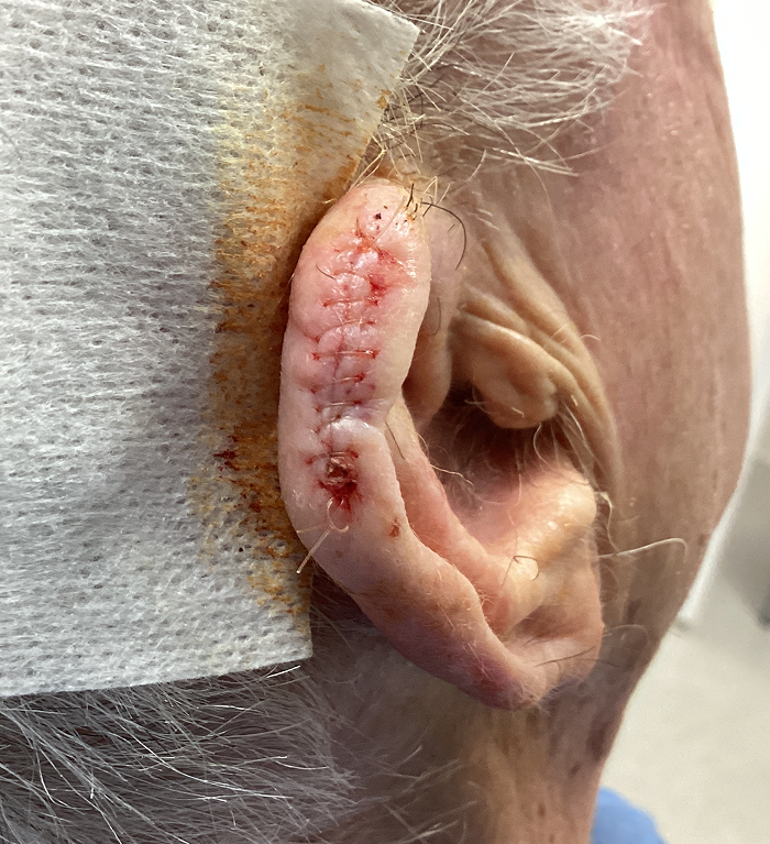 Right Helix Defect- Mohs Surgery Before Image