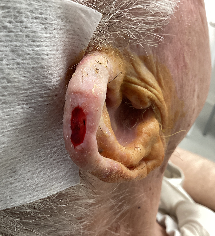Right Helix Defect- Mohs Surgery After Image