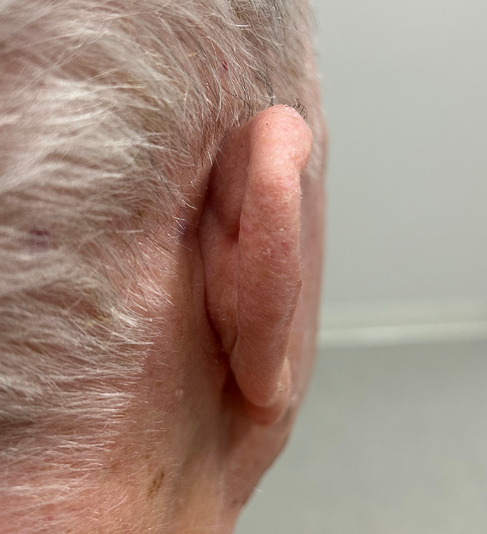 Right Helix Defect- Mohs Surgery After Image