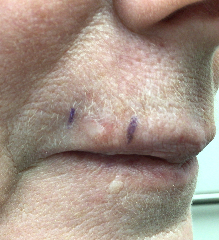 Upper Lip Defect – Mohs Surgery Before Image