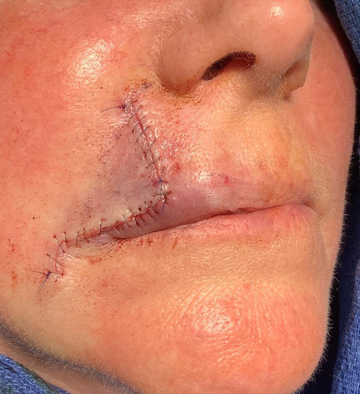 Upper Lip Defect – Mohs Surgery Before Image