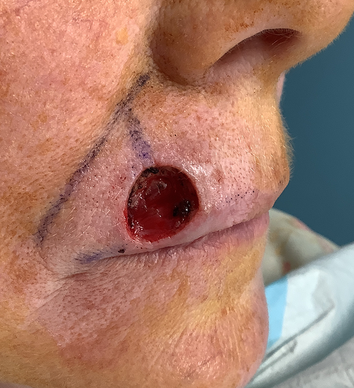 Upper Lip Defect – Mohs Surgery After Image