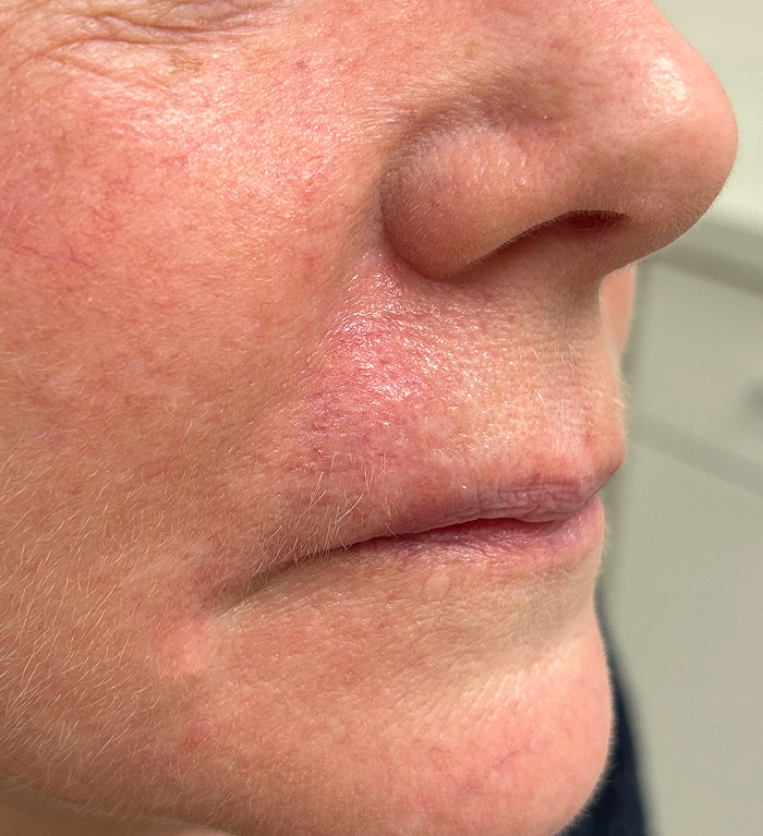 Upper Lip Defect – Mohs Surgery After Image