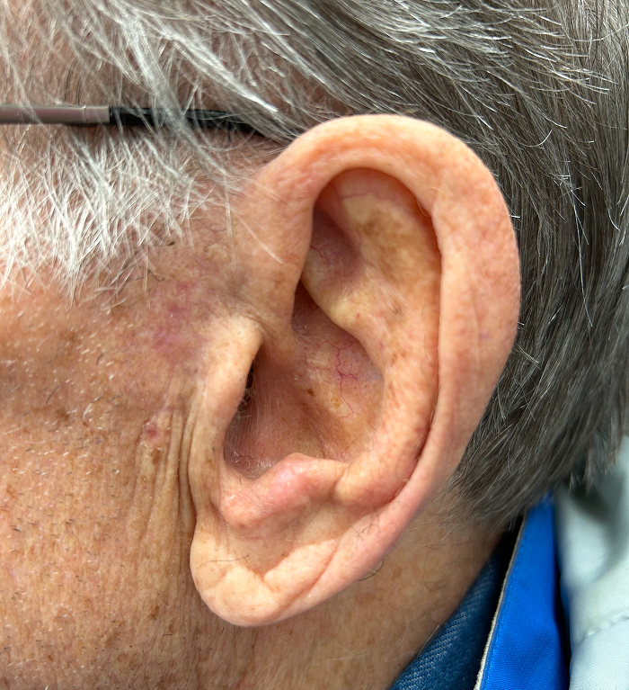 Antitragus Defect – Mohs Surgery After Image