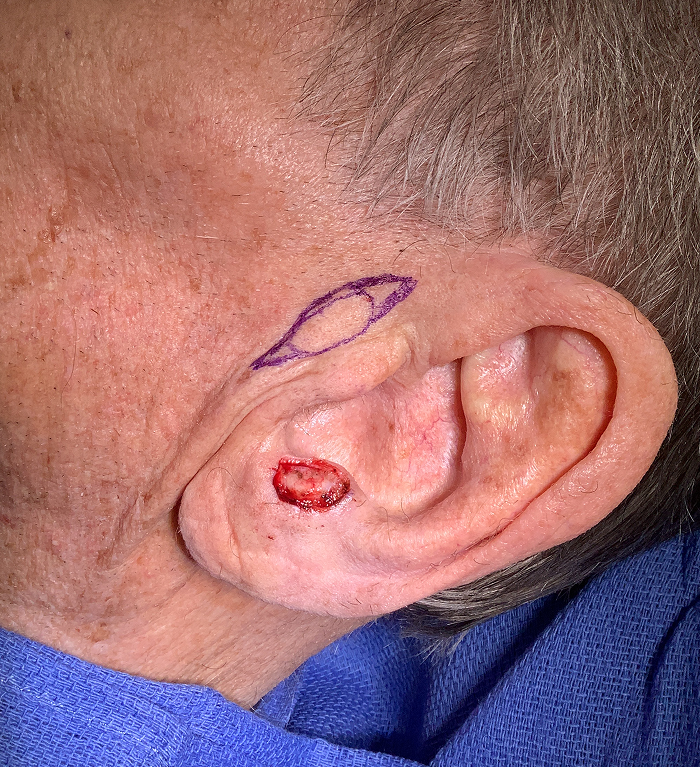Antitragus Defect – Mohs Surgery Before Image