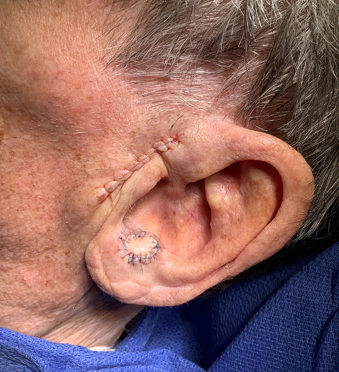Antitragus Defect – Mohs Surgery After Image