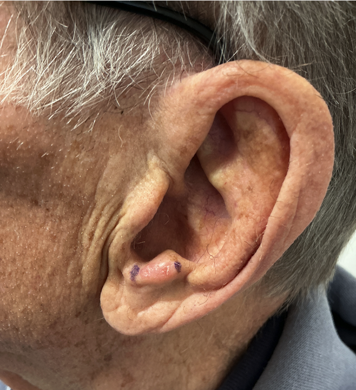 Antitragus Defect – Mohs Surgery Before Image