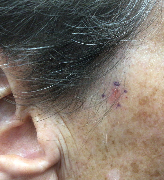 Sideburn Defect – Mohs Surgery Before Image