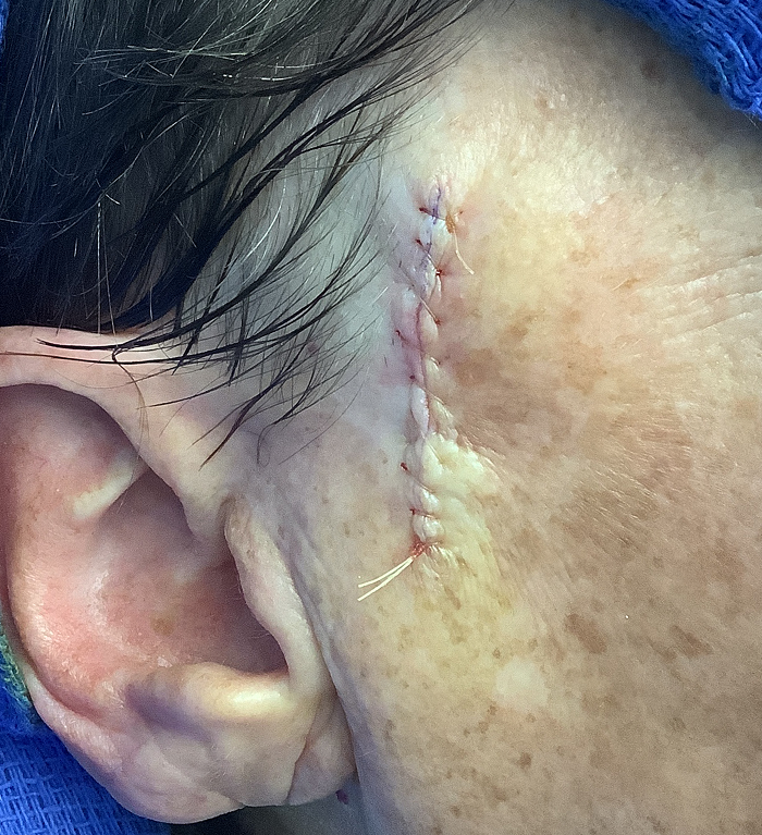 Sideburn Defect – Mohs Surgery Before Image