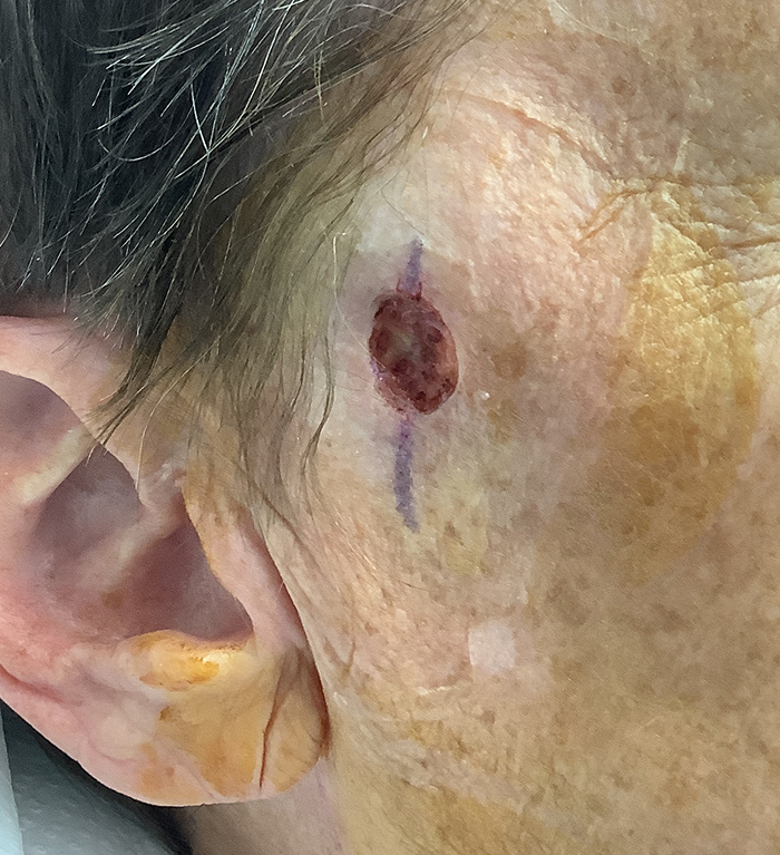 Sideburn Defect – Mohs Surgery After Image