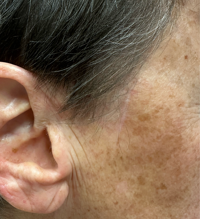 Sideburn Defect – Mohs Surgery After Image