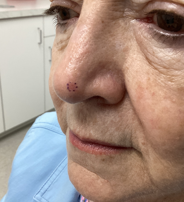 Nasal Tip Defect- Mohs Surgery Before Image