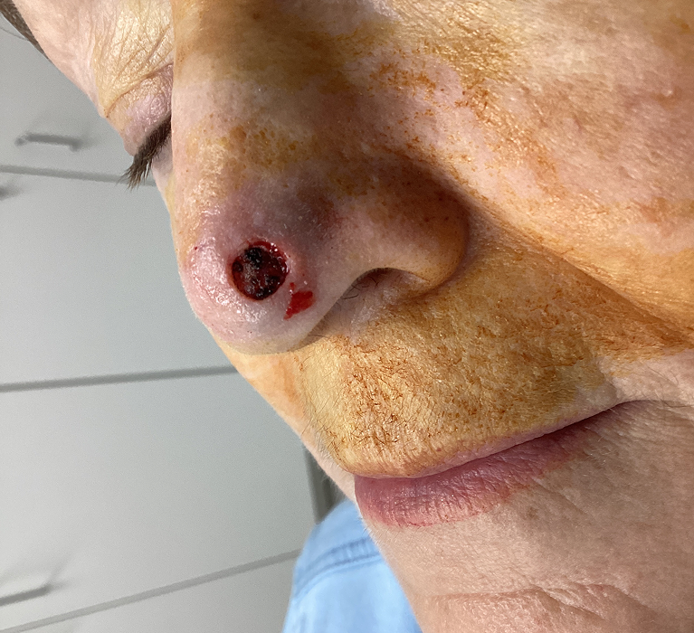 Nasal Tip Defect- Mohs Surgery After Image