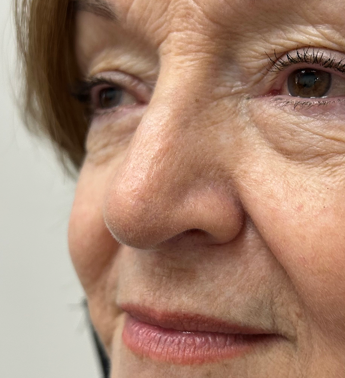 Nasal Tip Defect- Mohs Surgery After Image