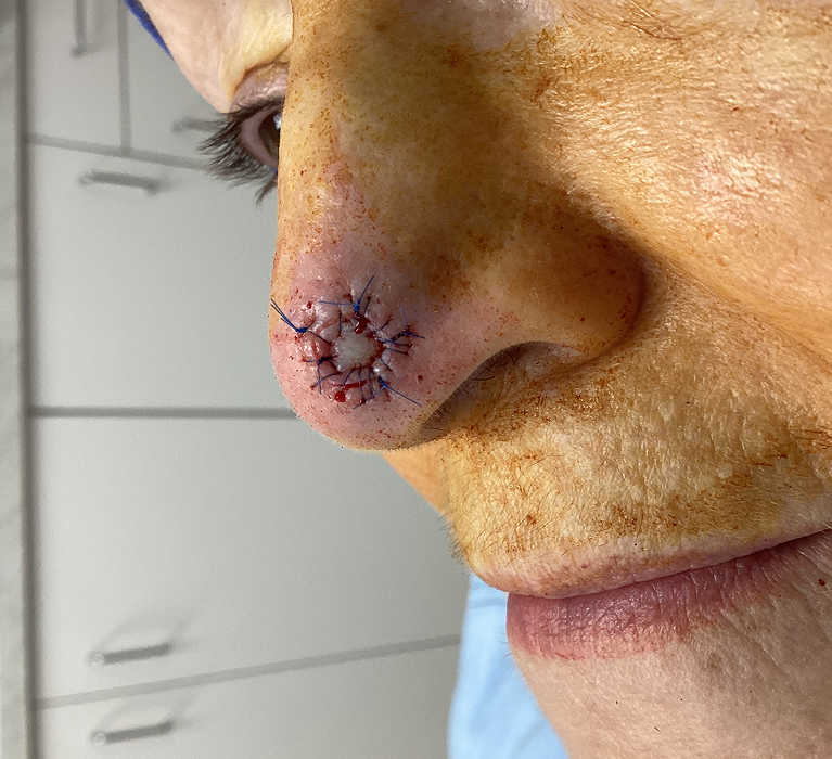 Nasal Tip Defect- Mohs Surgery Before Image