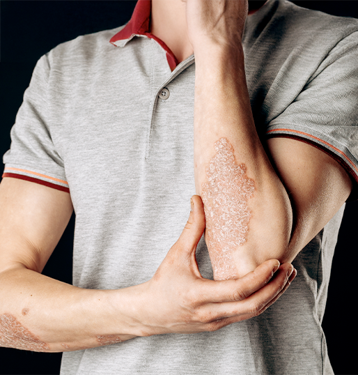 Psoriasis