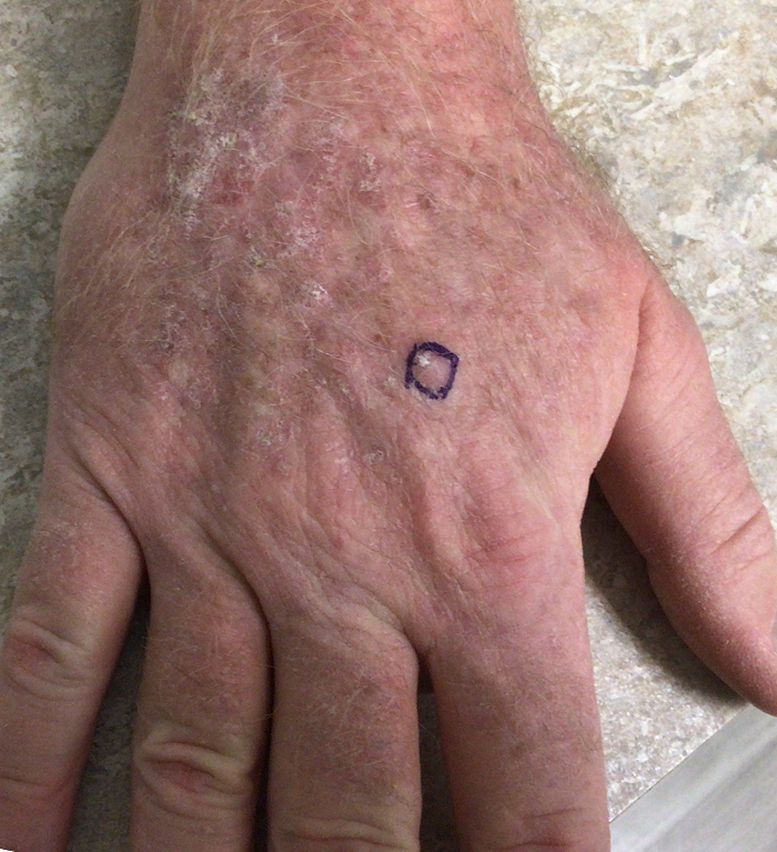 Right Hand Defect – Mohs Surgery Before Image