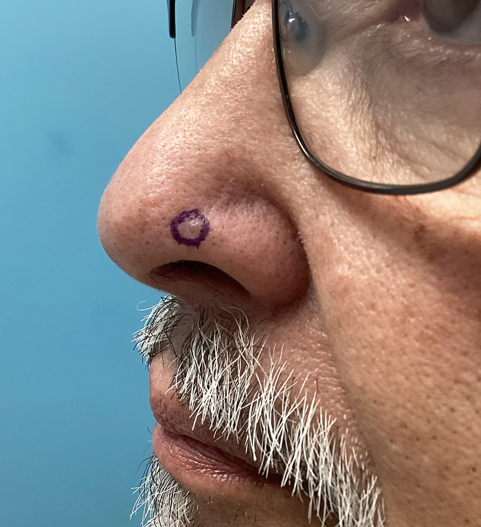 Left Nasal Tip Defect – Mohs Surgery Before Image
