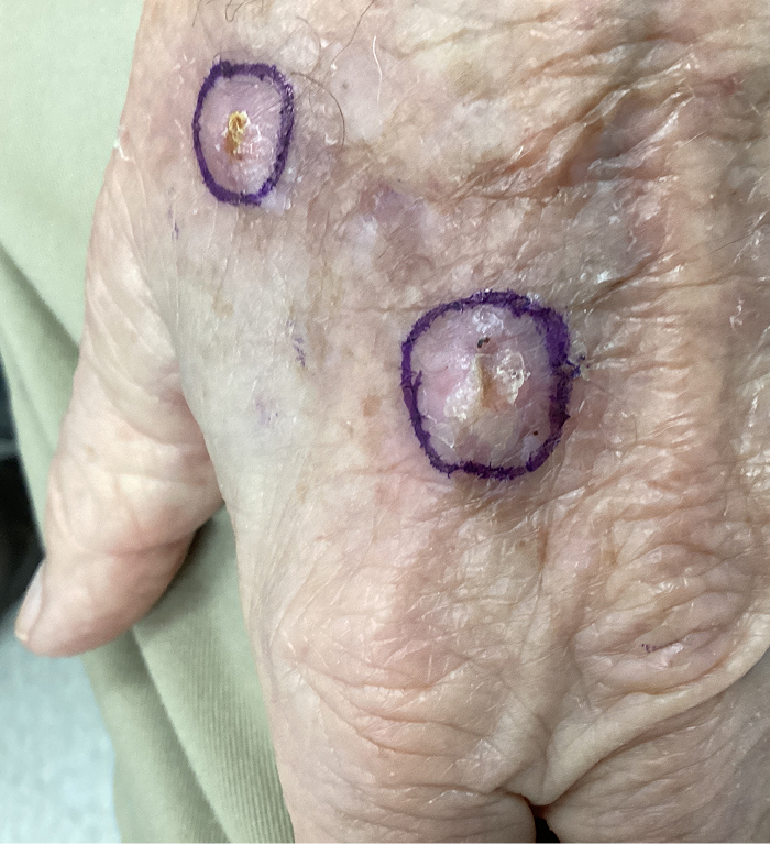Left Hand Defect – Mohs Surgery Before Image