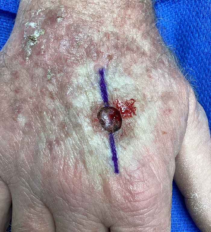 Right Hand Defect – Mohs Surgery After Image